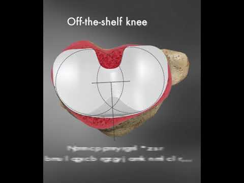 Rotational and improper coverage with off the shelf knee replacements video