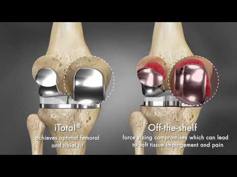 Off the shelve knee implant compromises video